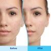 Picture of Differin 0.1% Adapalene  Gel Treatment (15 gm)